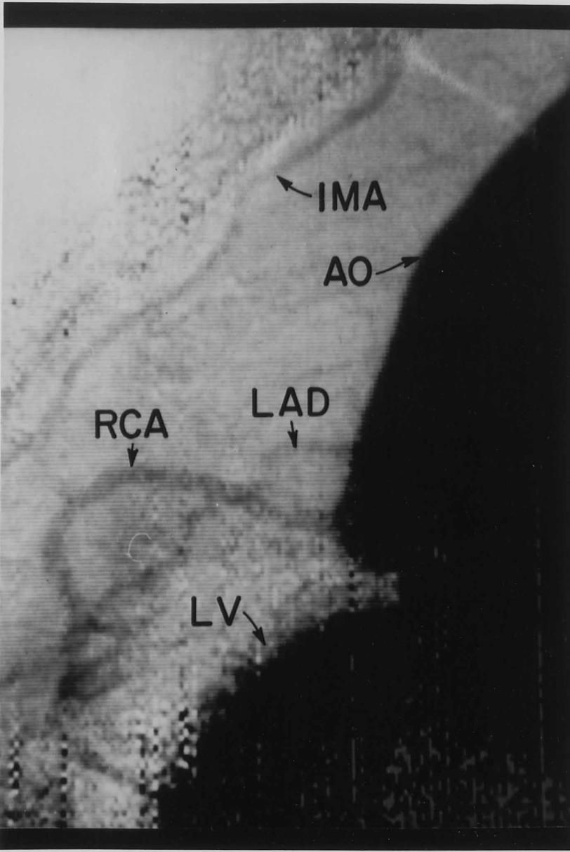 SSRL angiogram, May 1986